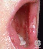 pic_Herpes-mouth.jpt.jpg